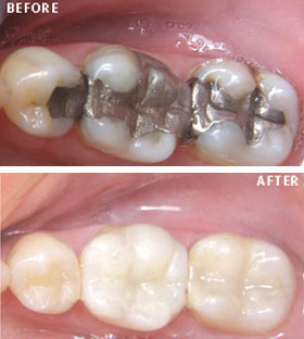 Dental clinic for Tooth Coloured Fillings