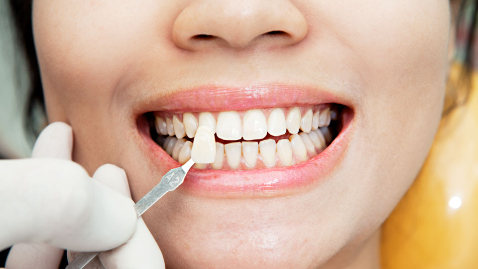 Dental clinic for Laminates