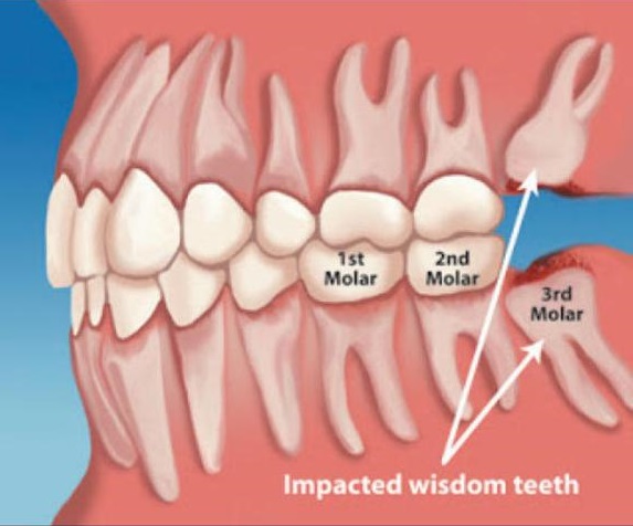 Impacted Tooth Surgeries